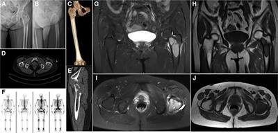 Case report and literature review: Primary leiomyosarcoma of the bone in the trochanteric region of the femur